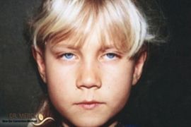 Ohren anlegen Bild nach OP 6